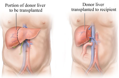 Living Donor Transplant : How it Works