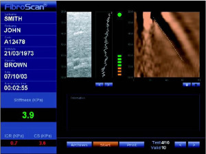 Fibroscan_JohnSmith1